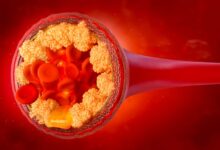 Colesterolo LDL, il colesterolo cattivo