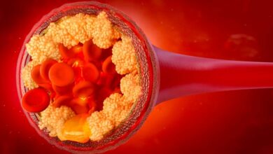 Colesterolo LDL, il colesterolo cattivo