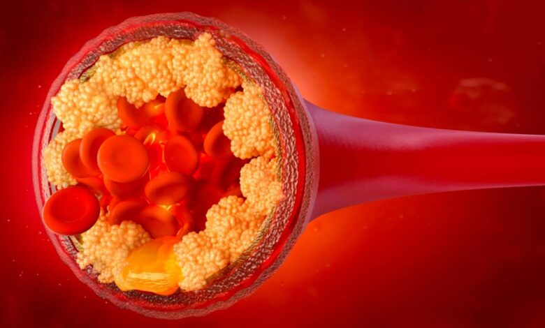 Colesterolo LDL, il colesterolo cattivo
